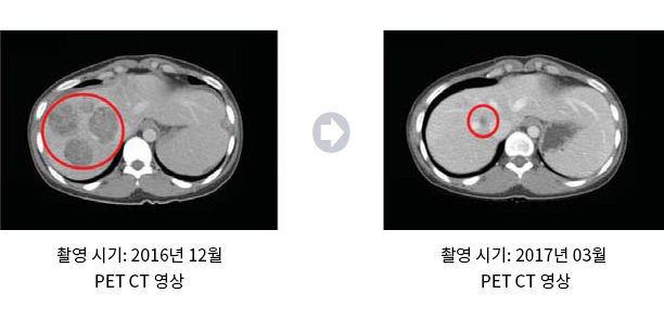 난소암에서의 호전 사례