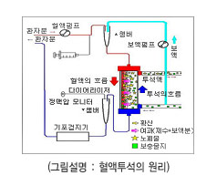 혈액투석의 원리