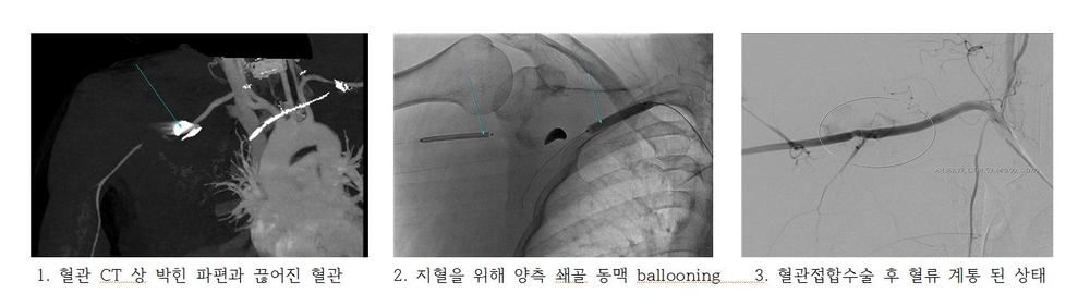 쇄골동맥 접합수술 과정