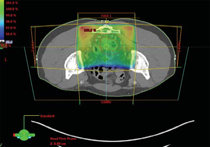 직장암환자의 3D-CRT 치료계획