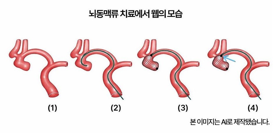 뇌동맥류 치료에서 웹의 모습 - (1) 전교통동맥의 뇌동맥류 (2) 미세카테터로 뇌동맥류를 선택한 모습 (3) 웹을 뇌동맥류 안으로 삽입한 상태 (4) 웹을 밀면서 위치를 조절해 뇌동맥류 안에 잘 삽입한 모습